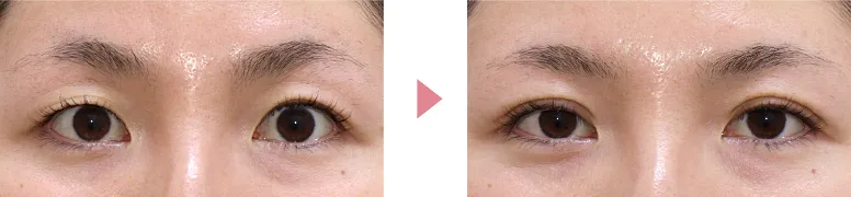 二重写真