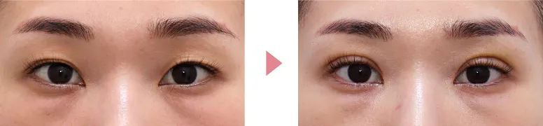 二重写真